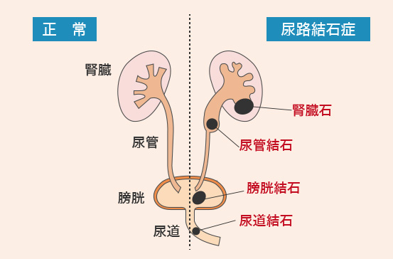 尿路結石