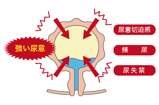 切迫性尿失禁（過活動性膀胱）