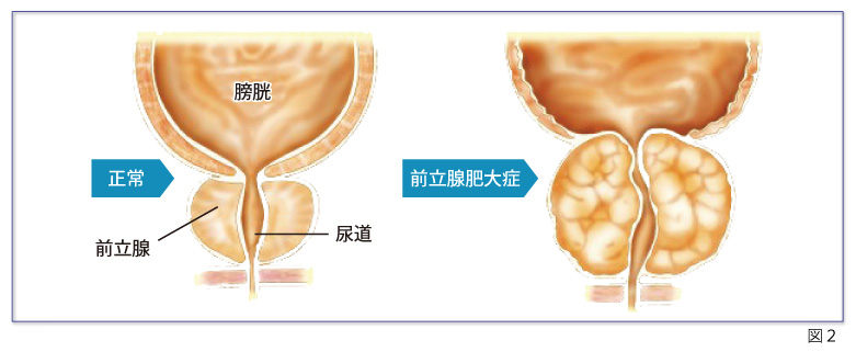 前立腺肥大症